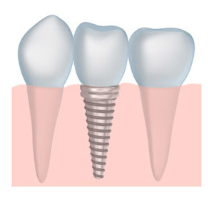 Image of a dental implant and a dental crown next to natural teeth