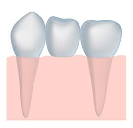 Image of a dental crown and dental bridge by White Family Dental